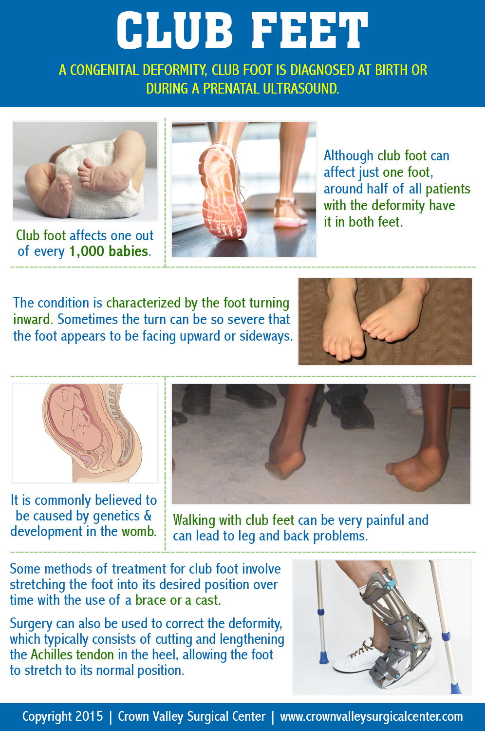 Club Feet by Crown Valley Cosmetic Surgery - Infographics